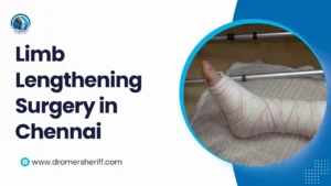 Limb Lengthening Surgery in Chennai