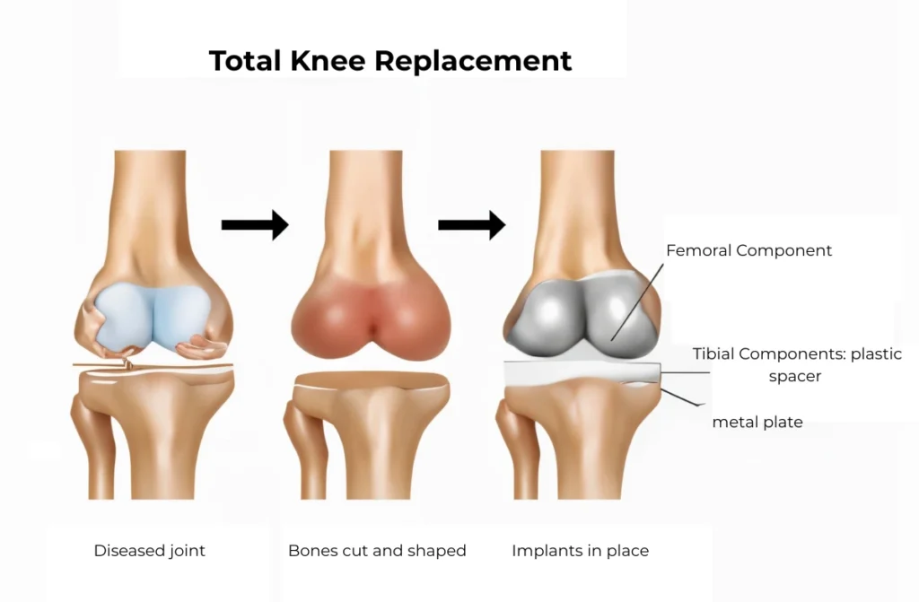 Best Knee Replacement Surgeon In India