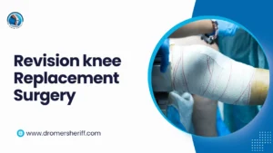 revision knee replacement surgery