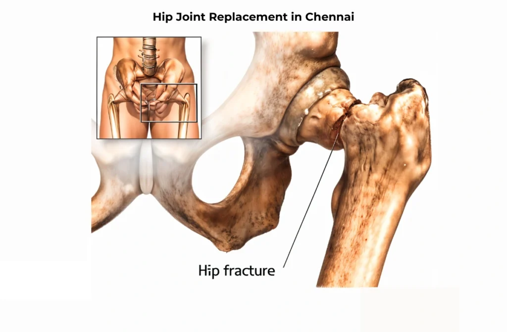 Hip Joint Replacement in Chennai