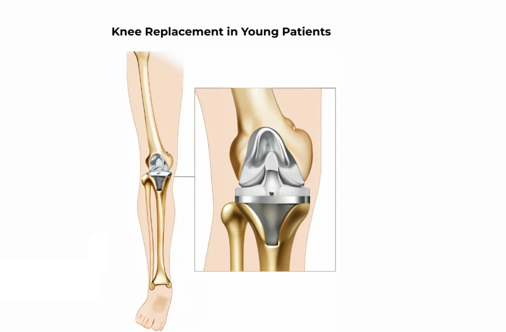 Knee Replacement in Young Patients