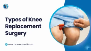 Types of Knee Replacement Surgery