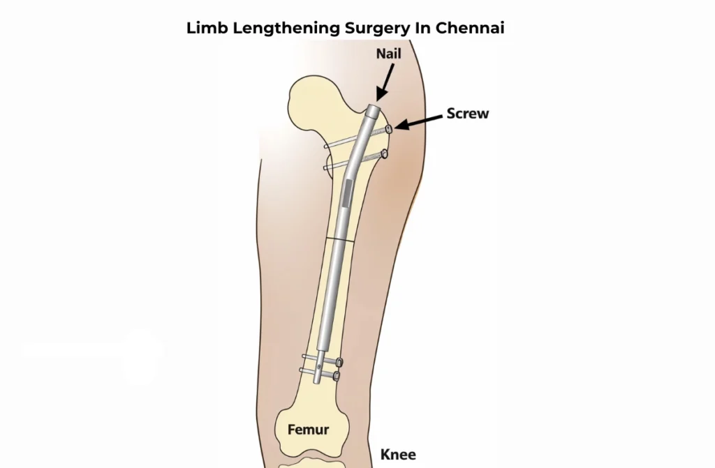 Limb Lengthening Surgery In Chennai