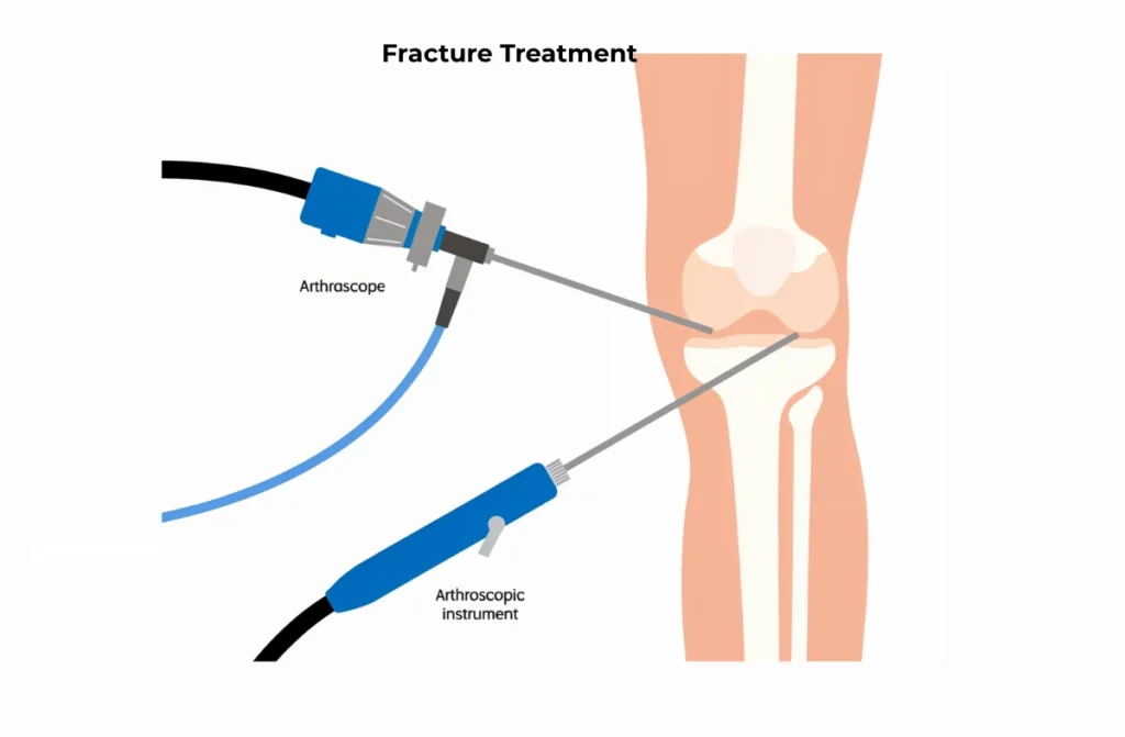 Knee Arthroscopy Recovery Time