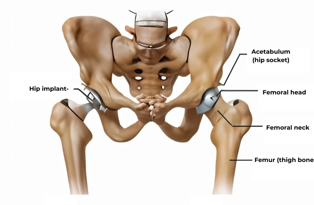 Hemi hip replacement in chennai