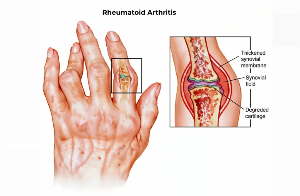 Rheumatoid Arthritis Specialist in Chennai