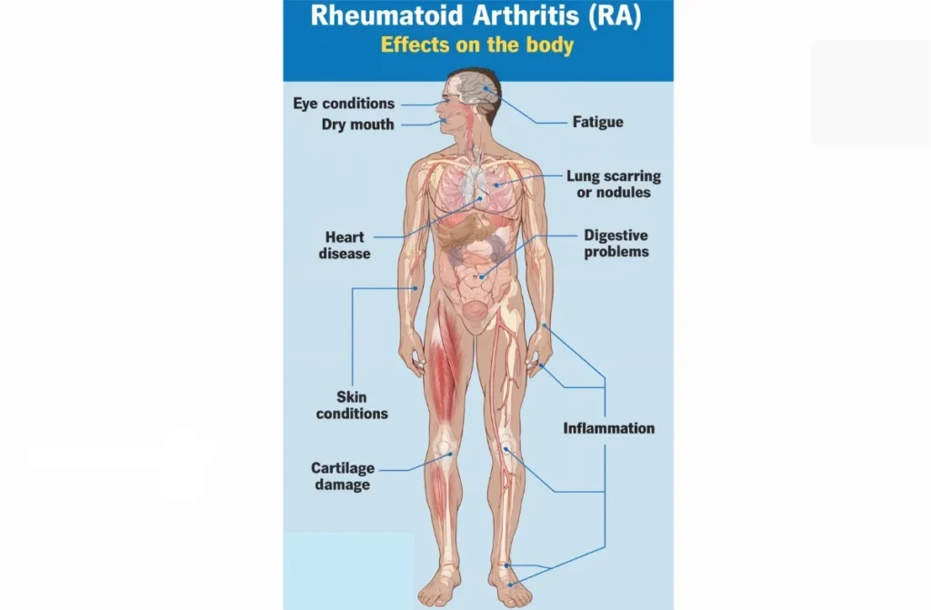 Rheumatoid Arthritis Treatment in Chennai
